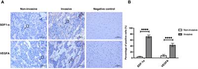 SDF-1α/MicroRNA-134 Axis Regulates Nonfunctioning Pituitary Neuroendocrine Tumor Growth via Targeting VEGFA